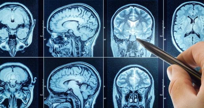 Avance en la neurocirugía: Nueva técnica revoluciona el tratamiento de hematomas y hemorragias cerebrales