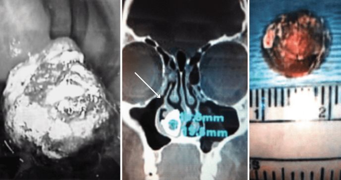 Rinolito en la cavidad nasal: Detectan masa calcificada que permaneció 42 años en un adulto de 48 años