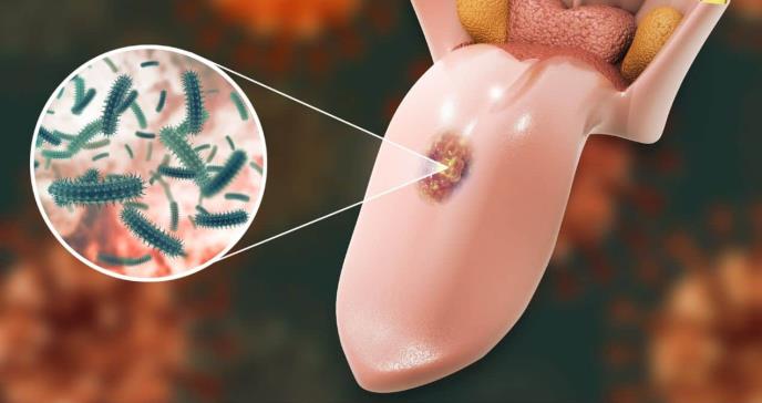 Bultos, llagas y toser sangre: Estos son los primeros síntomas para reconocer el cáncer de lengua