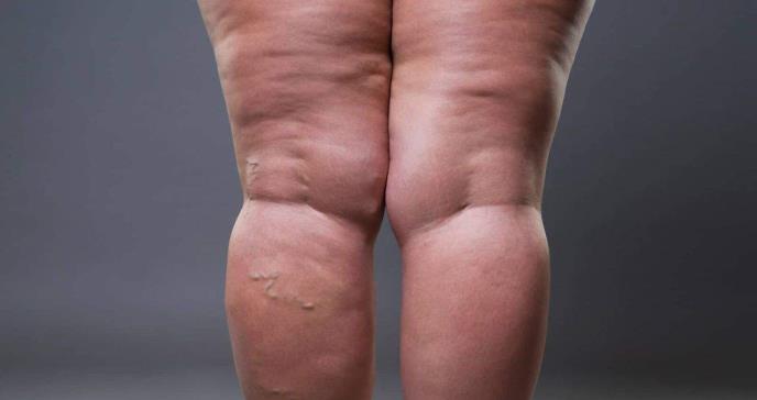 Por qué el lipedema y las ´piernas gruesas´ no son lo mismo: ¿Cómo diferenciarlas?