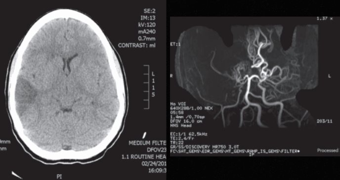 Mujer con migraña, visión borrosa y accidente cerebrovascular es diagnosticada con enfermedad de moyamoya