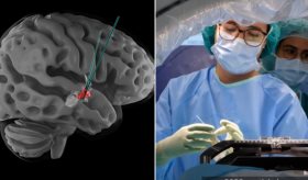 Lesionados medulares vuelven a caminar tras estimular una región cerebral no relacionada con lo locomotor