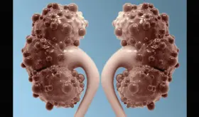 Dolor de espalda, hipertensión, llenura y otros síntomas de la enfermedad renal poliquística