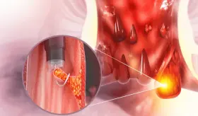 Sangrado, picazón, dolor y más: Lo que debes saber sobre las hemorroides