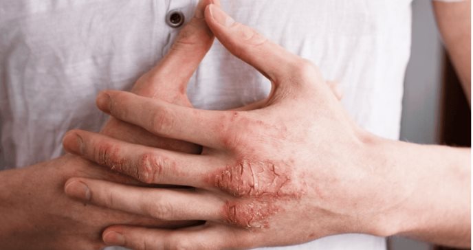 Cómo la inflamación afecta a la psoriasis y qué hábitos pueden aliviar sus síntomas