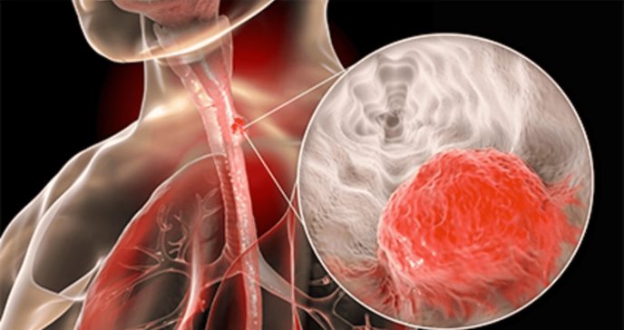 Diagnóstico tardío de cáncer de esófago: Desestiman hallazgos iniciales mientras la condición avanzaba