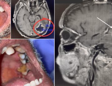 Higiene bucal deficiente ocasiona absceso cerebral por dos bacterias odontogénicas en adulto mayor