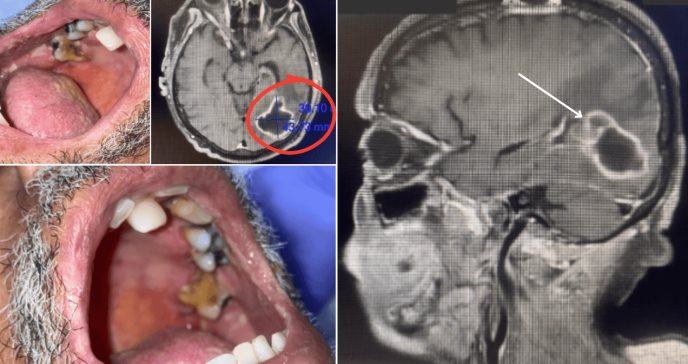 Higiene bucal deficiente ocasiona absceso cerebral por dos bacterias odontogénicas en adulto mayor