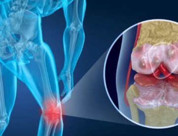 Desarrollan prueba basada en líquido sinovial para diagnosticar artritis de rodilla en primeras etapas