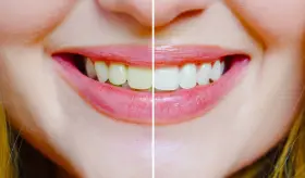 ¿Qué ocasiona la tonalidad amarilla en los dientes? Conoce cómo puedes prevenir la dentinogénesis