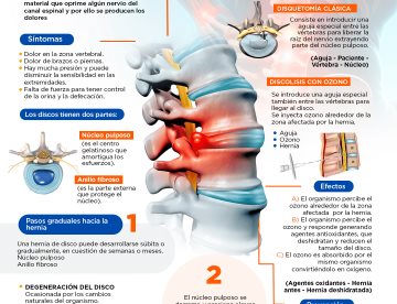 HERNIA DE DISCO