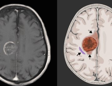 Avances del tratamiento personalizado del glioblastoma: organoides replican la respuesta a células CAR-T