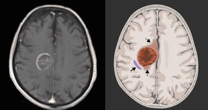 Avances del tratamiento personalizado del glioblastoma: organoides replican la respuesta a células CAR-T