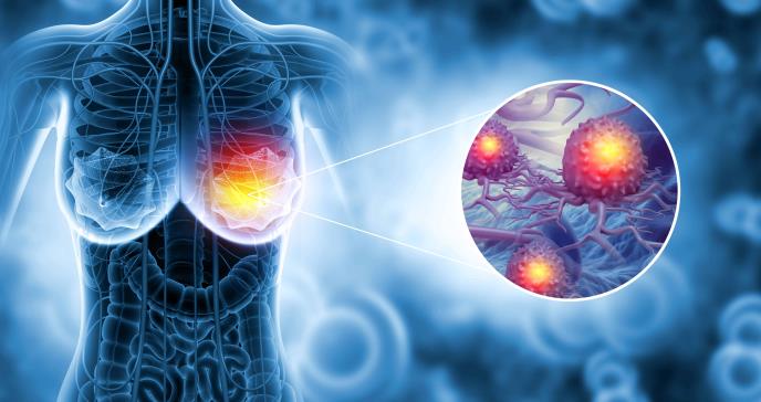 Panorama en evolución del cáncer de mama