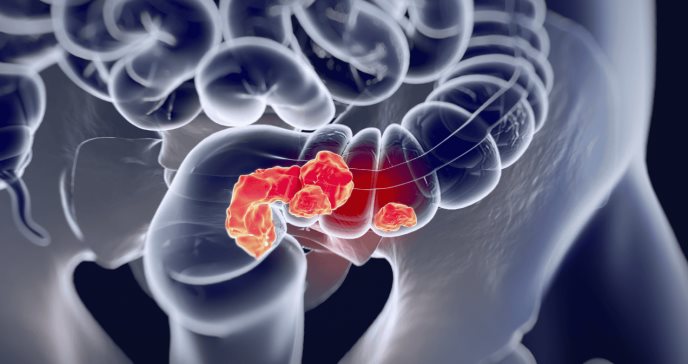 Aumento alarmante de cáncer colorrectal en menores de 50 años: Dieta y estilo de vida, posibles culpables