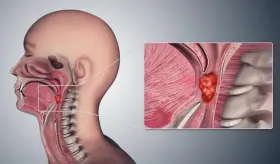 Disfonía, ronquera y cambios en la voz: Señales que podrían ocultar un tumor