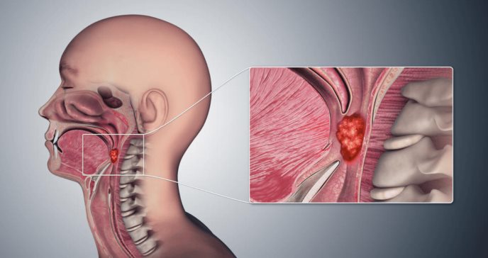 Disfonía, ronquera y cambios en la voz: Señales que podrían ocultar un tumor