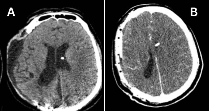 Paciente masculino presenta un edema cerebral maligno tras craneoplastia