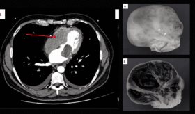 Confunden tumor benigno con mixofibrosarcoma maligno en paciente de 65 años