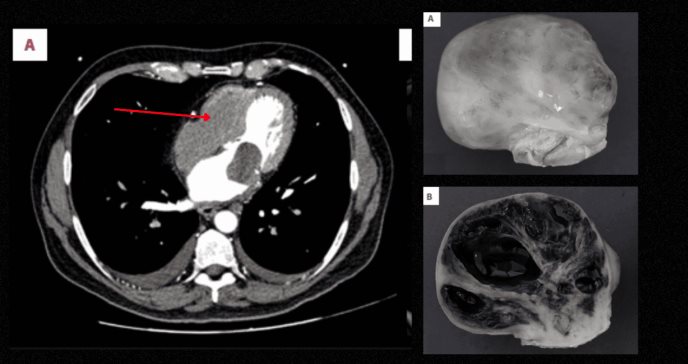 Confunden tumor benigno con mixofibrosarcoma maligno en paciente de 65 años