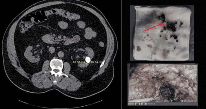 Hallan piedra infectada de 2 cm en el parénquima renal junto a múltiples cálculos en paciente de 65 años