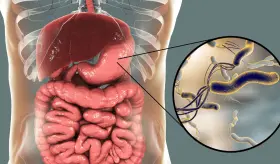 ´Helicobacter pylori´, la infección que causa gastritis, úlceras y cáncer