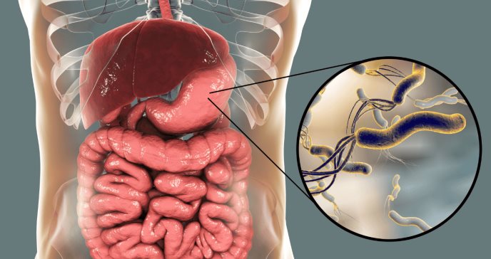 ´Helicobacter pylori´, la infección que causa gastritis, úlceras y cáncer