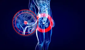 Cómo gestionar los síntomas y prevenir complicaciones de la Hiperplasia Prostática Benigna