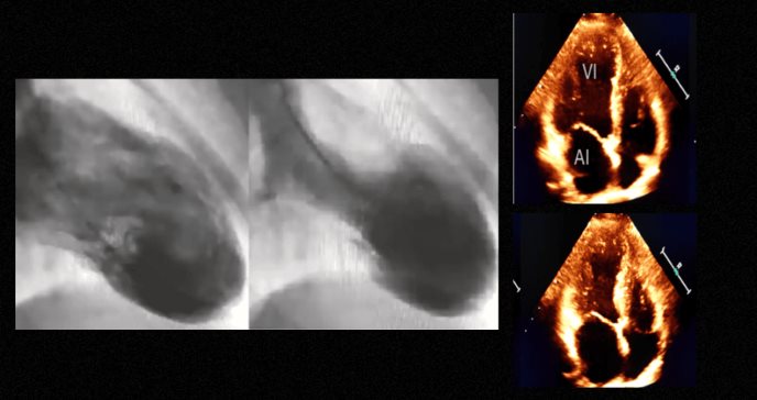 Síndrome de Takotsubo: Infarto miocardio por estrés emocional en mujer con hipertensión e hipotiroidismo