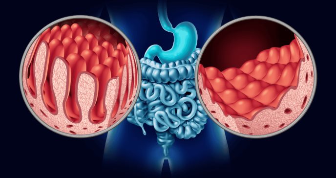 El impacto de la ingesta calórica y de grasas en los trastornos gastrointestinales de niños celíacos