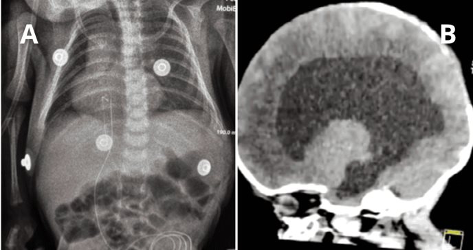 Neonato presenta agenesia del cuerpo calloso, anomalías cardíacas, oculares y genitales asociadas a TOF