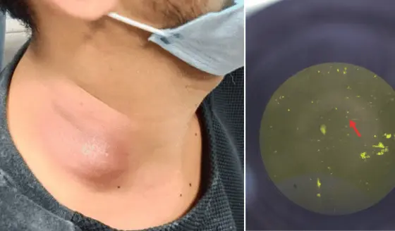 Inflamación prolongada en el cuello revela diagnóstico de tuberculosis extrapulmonar en hombre de 26 años