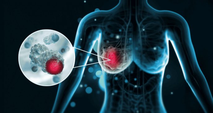 Combinación de giredestrant y palbociclib reduce en un 75% la proliferación celular en cáncer de mama