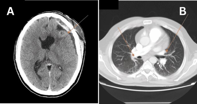 Paciente post-craneotomía presenta trombosis y embolia pulmonar a pesar del filtro de vena cava