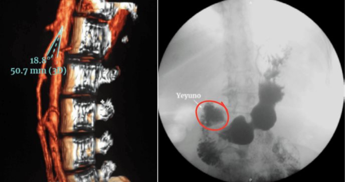 Paciente de leucemia linfoblástica aguda presenta obstrucción duodenal por compresión de vasos sanguíneos