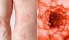 La Psoriasis estaría relacionada con aparición de enfermedades intestinales inflamatorias como el Crohn 