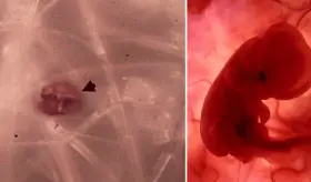 Microplásticos presentes en la placenta podrían estar contribuyendo al riesgo de partos prematuros