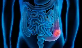 Mini-examen clínico: ¿Cuánto sabe sobre la colitis ulcerosa?