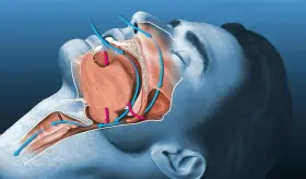 Mini-examen clínico: ¿Puede tratar y controlar la apnea obstructiva del sueño?