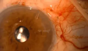 Colesterol "bueno" y glaucoma: Advierten de nuevo factor de riesgo en mayores de 55 años