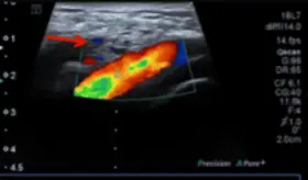 Detectan trombosis de la vena esperm&aacute;tica en joven de 21 a&ntilde;os con dolor testicular y fiebre
