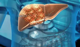 Cirugía metabólica reduce en un 72% el riesgo de cáncer de hígado en pacientes con cirrosis
