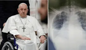 Confirman nuevo diagnóstico del Papa Francisco: Sufre neumonía bilateral ¿Qué es y cómo se trata? 