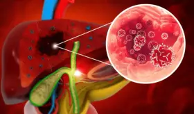H&iacute;gado graso asociado a disfunci&oacute;n metab&oacute;lica: Riesgo de cirrosis y enfermedad cardiovascular