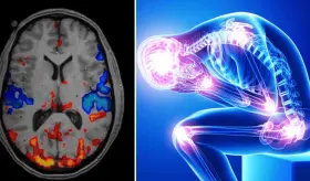 Migraña y fibromialgia: cómo la disfunción del sistema nervioso central amplifica el dolor crónico