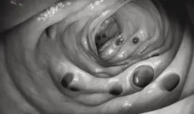 Desmienten que la diverticulosis no complicada se asocia con dolor abdominal y problemas intestinales