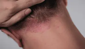 Desmitificando 8 mitos sobre la psoriasis: ¿Es contagiosa? ¿Es solo piel seca? Lo que necesitas saber