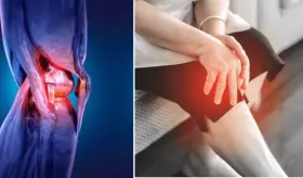 El sobrepeso aumenta la discapacidad por artrosis en mujeres postmenopáusicas, según estudio