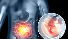 MSTFCRC establece un estándar del 90 % en la idoneidad de la preparación intestinal para colonoscopias