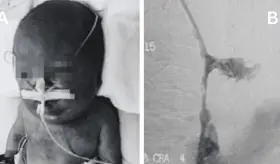 Neonato present&oacute; s&iacute;ndrome de vena cava superior por trombosis tras 90 d&iacute;as de cat&eacute;ter venoso central